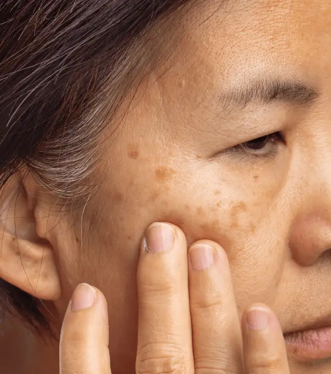 Skin Changes In Perimenopause/ Menopause